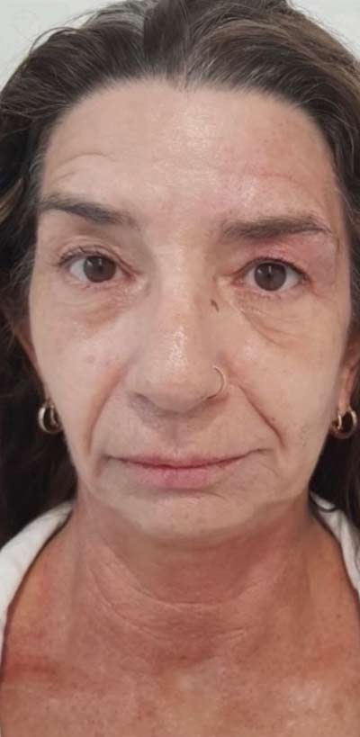 After-Full Facelift with Plasma Fibroblasting